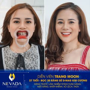 Hình ảnh bọc 20 răng sứ D-mag kim cương của Diễn vien Trang Moon – Ca 71