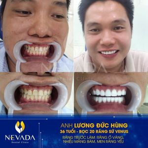 Hình ảnh bọc 20 răng sứ Venus của KH Lương Đức Hùng – Ca 72