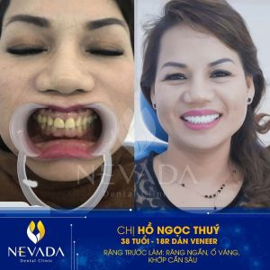 Hình ảnh dán sứ veneer 18 chiếc răng của KH Hồ Ngọc Thúy – Ca 73