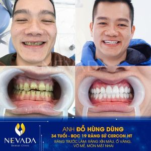Hình ảnh bọc 19 răng sứ Cercon HT cuẩ KH Đỗ Hùng Dũng – Ca 74