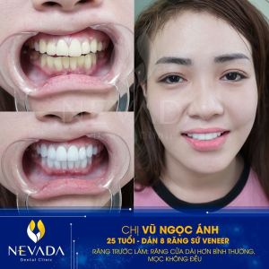 Hình ảnh dán sứ Veneer 8 chiếc răng của KH Vũ Ngọc Ánh – Ca 75