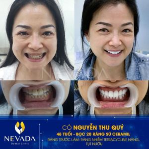 Hình ảnh bọc 20 răng sứ Ceramil của KH Nguyễn Thu Quý – Ca 76