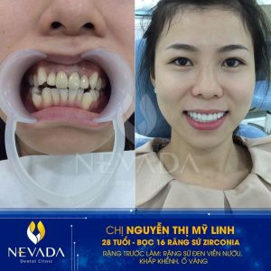 Hình ảnh bọc răng sứ Zirconia của KH Nguyễn Thị Mỹ Linh – Ca 77