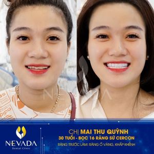 Hình ảnh bọc 16 răng sứ Cercon của KH Mai Thu Quỳnh – Ca 78
