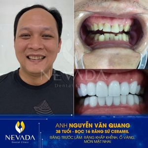 Hình ảnh bọc 16 răng sứ Ceramil của KH Nguyễn Văn Quang – Ca 79