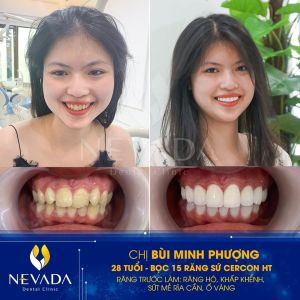 Hình ảnh bọc 15 răng sứ Cercon cho KH Bùi Minh Phượng – Ca 80