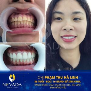 Hình ảnh bọc 16 răng sứ Zirconia của KH Phạm Thu Hà Linh – Ca 81