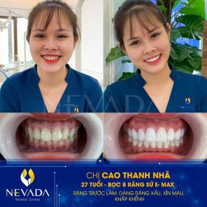 Hình ảnh bọc 8 răng sứ E-max của KH Cao Thanh Nhã – Ca 82