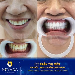 Hình ảnh bọc 22 răng sứ Venus của KH Trần Thị Mến – Ca 83