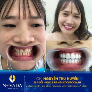 Hình ảnh bọc răng sứ Cercon HT của KH Nguyễn Thu Huyền – Ca 84