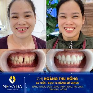 Hình ảnh bọc 12 răng sứ Venus của KH Hoàng Thu Hồng – Ca 85