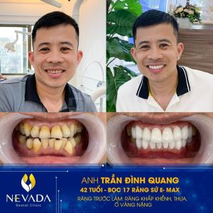 Hình ảnh bọc 17 răng sứ E-max của KH Trần Đình Quang – Ca 86