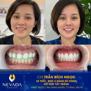 Hình ảnh bọc răng sứ kết hợp tẩy trắng răng của KH Trần Bích Ngọc – Ca 87