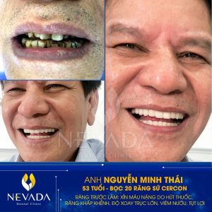 Hình ảnh bọc răng sứ Cercon của KH Nguyễn Minh Thái – Ca 88