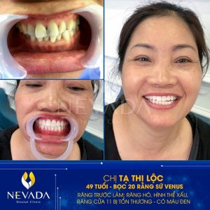Hình ảnh bọc 20 răng sứ Venus của KH Tạ Thị Lộc – Ca 89