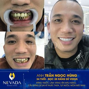 Hình ảnh bọc 20 răng sứ Venus của KH Trần Ngọc Hùng – Ca 90