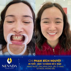 Hình ảnh bọc 18 răng sứ E-max của KH Phạm Bích Nguyệt – Ca 92
