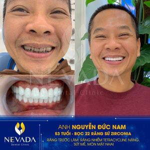 Hình ảnh bọc răng sứ của KH Nguyễn Đức Nam – Ca 93