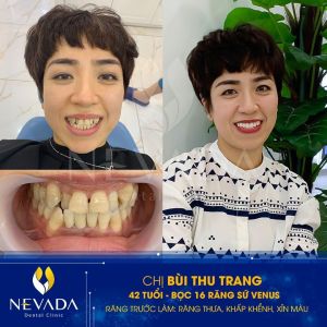 Hình ảnh bọc 16 răng sứ Venus của KH Bùi Thu Trang - Ca 94