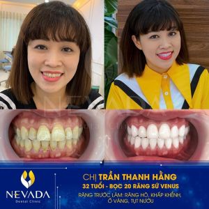 Hình ảnh bọc 20 răng sứ Venus của KH Trần Thanh Hằng – Ca 95