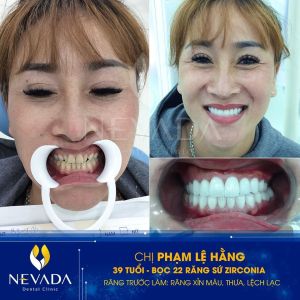 Hình ảnh bọc răng sứ Zirconia của KH Phạm Lệ Hằng – Ca 96