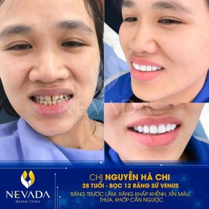 Hình ảnh bọc 12 răng sứ Venus của KH Nguyễn Hà Chi – Ca 97