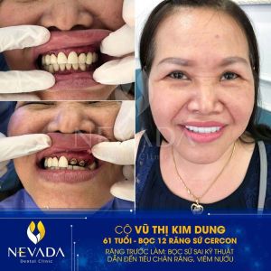 Hình ảnh bọc 12 răng sứ Cercon của KH Vũ Thị Kim Dung – Ca 98