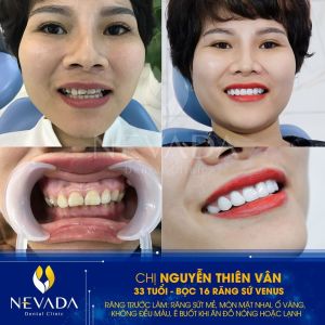 Hình ảnh bọc 16 răng sứ venus của KH Nguyễn Thiên Vân – Ca 99