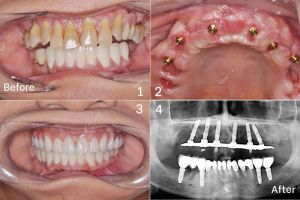 Hình ảnh trồng răng implant – Nha khoa Peace Dentistry  - Ca 1