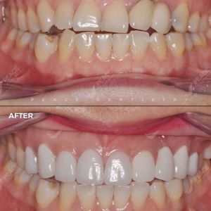 Hình ảnh dán sứ Veneer kết hợp thay cầu răng sứ, tẩy trắng răng - Nha khoa Peace Dentistry - Ca 10