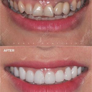 Hình ảnh dán sứ Veneer kết hợp thay cầu răng sứ, tẩy trắng răng - Nha khoa Peace Dentistry - Ca 10