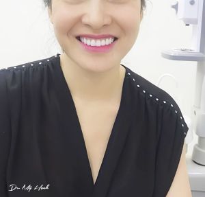 Hình ảnh dán sứ Veneer kết hợp thay cầu răng sứ, tẩy trắng răng - Nha khoa Peace Dentistry - Ca 10