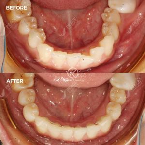 Hình ảnh niềng răng invisalign – Nha khoa Peace Dentistry - Ca 11