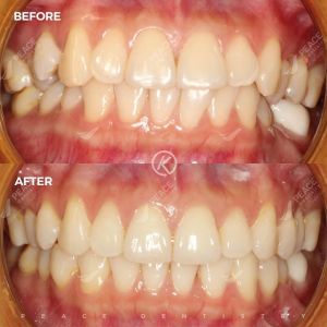 Hình ảnh niềng răng invisalign – Nha khoa Peace Dentistry - Ca 11