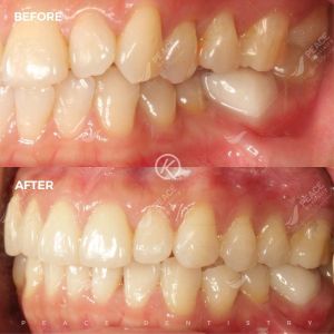 Hình ảnh niềng răng invisalign – Nha khoa Peace Dentistry - Ca 11