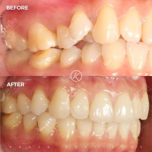 Hình ảnh niềng răng invisalign – Nha khoa Peace Dentistry - Ca 11