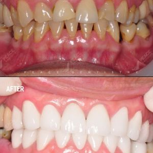 Hình ảnh trồng răng implant và thẩm mỹ răng sứ nguyên hàm – Nha khoa Peace Dentistry  - Ca 12