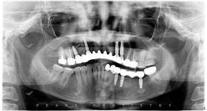 Hình ảnh thay thế cầu răng sứ bằng trồng răng implant – Nha khoa Peace Dentistry  - Ca 14