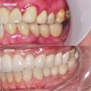 Hình ảnh thay thế cầu răng sứ bằng trồng răng implant – Nha khoa Peace Dentistry  - Ca 14