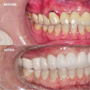 Hình ảnh thay thế cầu răng sứ bằng trồng răng implant – Nha khoa Peace Dentistry  - Ca 14