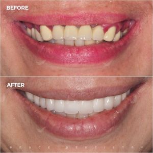 Hình ảnh thay thế cầu răng sứ bằng trồng răng implant – Nha khoa Peace Dentistry  - Ca 14