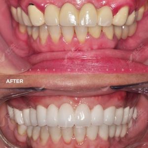 Hình ảnh thay thế cầu răng sứ bằng trồng răng implant – Nha khoa Peace Dentistry  - Ca 14