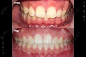 Hình ảnh niềng răng mắc cài – Nha khoa Peace Dentistry – Ca 15