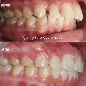 Hình ảnh niềng răng mắc cài – Nha khoa Peace Dentistry – Ca 15