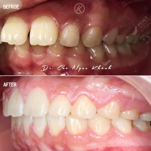 Hình ảnh niềng răng mắc cài – Nha khoa Peace Dentistry – Ca 15