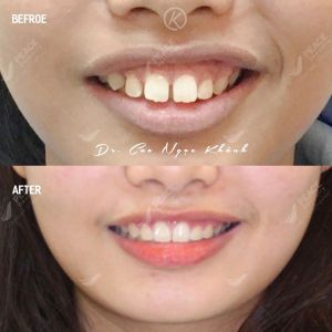 Hình ảnh niềng răng mắc cài – Nha khoa Peace Dentistry – Ca 15