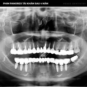 Hình ảnh trồng răng implant, thẩm mỹ răng sứ, điều chỉnh khớp cắn của nữ KH 40 tuổi – Nha khoa Peace Dentistry  - Ca 16