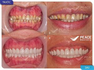 Hình ảnh bọc răng sứ - Nha khoa Peace Dentistry  - Ca 18