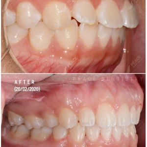 Hình ảnh niềng răng mắc cài của BN 15 tuổi – Nha khoa Peace Dentistry  - Ca 19