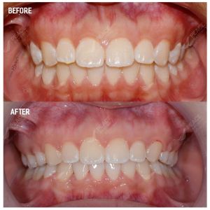 Hình ảnh niềng răng mắc cài của BN 15 tuổi – Nha khoa Peace Dentistry  - Ca 19